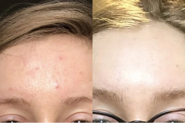 Before and after of Acne