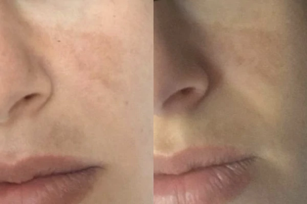 Before and after of Melasma