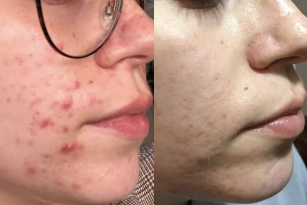 Before and after of Cystic Acne